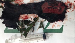 Ngã từ trên cây, cụ ông bị que gỗ đâm xuyên ngực trái