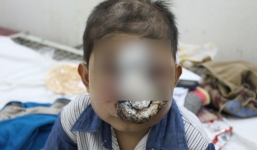 Bé trai ở Sóc Trăng bị 'bệnh lạ' ăn mòn khuôn mặt đã qua đời