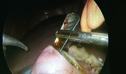 Cứu sống cô gái nuốt thìa vào bụng