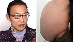 Cắt bỏ khối u nặng 31kg khỏi bụng nam bệnh nhân