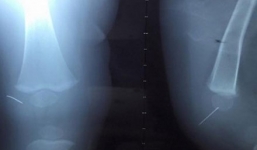 Bé trai 1 tuổi bị kim khâu đâm xuyên khớp