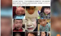 Giáo viên bất cẩn, 8 trẻ mẫu giáo Trung Quốc bị bỏng mắt