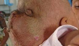 Bé sơ sinh suýt tử vong vì khối u khủng sau đầu