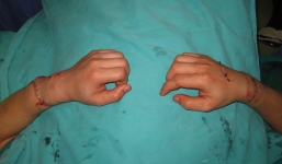 Nối thành công hai bàn tay bị đứt lìa