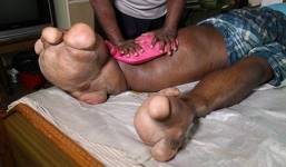 Người đàn ông có bàn chân nặng hơn 100kg do mắc bệnh lạ