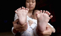Hy hữu bé sơ sinh có 31 ngón chân, ngón tay