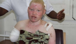 Hai người bạch tạng bị sát hại, cướp bộ phận cơ thể ở Malawi 