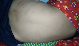 Bị mèo cào, bé trai 11 tuổi nhiễm bệnh dại tử vong