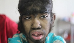 Lạ kỳ bé gái mắc hội chứng người sói hiếm gặp