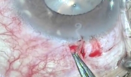 Giun đũa chó kí sinh trong mắt bệnh nhân ở Nghệ An