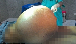 Khối u khủng 95kg trong bụng người phụ nữ Ấn Độ