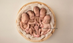 Hy hữu ca sinh 5 cần đến 50 y bác sĩ tại Úc