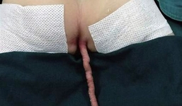 Kỳ lạ bé sơ sinh mọc đuôi dài gần 16cm