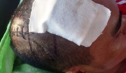 Nhân viên Spa bị côn đồ chém nhiều nhát vào đầu