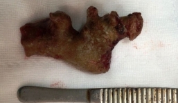 Phẫu thuật lấy sỏi thận khủng dài 11cm trong bụng bệnh nhân