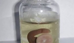 Vắt dài 3cm làm tắc mũi bệnh nhân nam 23 tuổi ở Tuyên Quang