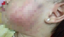 Hà Nội: Bé gái bị thâm tím người khi từ trường mầm non về