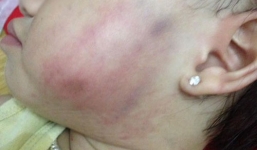 Vụ bé gái ở Hà Nội bị bầm tím người khi đi học: Tạm đình chỉ cơ sở mầm non