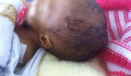 Nghi vấn về vết khâu bí ẩn trên đầu bé sơ sinh ở Lâm Đồng