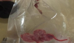 Bác sĩ 'quên' gạc sau khi phẫu thuật bị tạm đình chỉ công tác