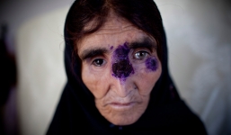 Hãi hùng căn bệnh 'ăn thịt người' càn quét Trung Đông