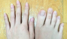 Thành 'ngôi sao' trên mạng xã hội nhờ ngón chân dài như ngón tay