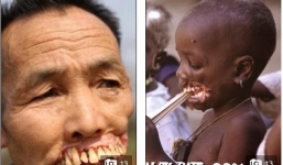 10 căn bệnh khủng khiếp nhất lịch sử y học