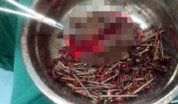 Phẫu thuật lấy 200 cái đinh cùng tăm, đồng xu trong bụng cậu bé