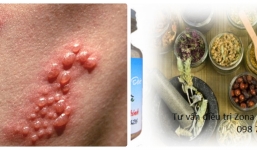 Cách chữa Zona thần kinh hiệu quả nhanh chóng tại nhà