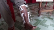 Video: Tận cùng nỗi đau của người đàn ông phải đeo 'gông' ở chân