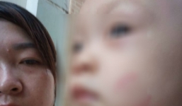 Hà Nội: Bé 20 tháng tuổi nghi bị cắn bầm tím người khi đi học