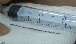 Bác sĩ lấy kim khâu 4cm trong họng bé gái 1 tuổi