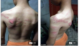 Trung Quốc: Thầy giáo đánh học sinh thâm tím người bằng dây điện