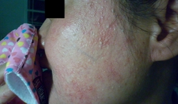 Những tai nạn ngoài ý muốn khi dùng kem trắng da cấp tốc