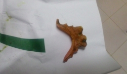 Nữ bệnh nhân thủng ruột già vì răng giả