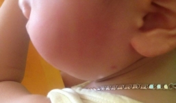 Đi học trường mầm non tư thục về, cháu bé 18 tháng bị bầm tím mặt mày