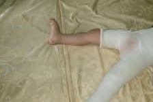 Tuyên Quang: Cô giáo đạp trẻ 3 tuổi gãy xương đùi vì không chịu ngủ trưa?