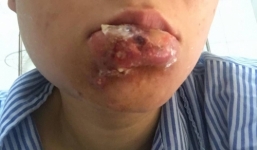 Cô gái phải cắt bỏ môi do tiêm chất làm đầy ở spa