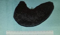 Phẫu thuật lấy búi tóc hơn 6kg trong dạ dày người phụ nữ