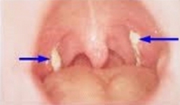 Xuất hiện bệnh 'lạ' khiến 3 người tử vong ở Bình Phước: Bộ Y tế lên tiếng