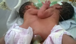 Hy hữu, cặp song sinh dính liền từ ngực đến bụng ở Hà Giang