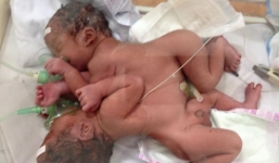 Cặp song sinh dính liền nhau ở Hà Giang nhập viện Bệnh viện Việt Đức