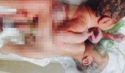 Sức khỏe cặp song sinh dính liền ở Hà Giang