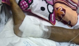 Bộ Y tế yêu cầu làm rõ nguyên nhân mổ nhầm chân ở Bệnh viện Việt Đức