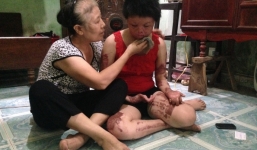 Mẹ cô gái bị chồng tưới xăng thiêu sống gửi thư đến Bộ trưởng Y tế