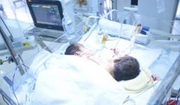 Cặp song sinh dính liền ở Hà Giang tử vong