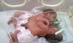 Cha của cặp song sinh dính liền đau đớn chứng kiến cảnh hai con tử vong