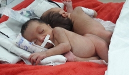 Khẩn cấp phẫu thuật cho cặp song sinh dính liền hiếm gặp