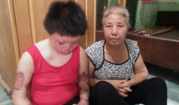 Người vợ trẻ bị chồng tẩm xăng đốt:  Bắt giam người chồng