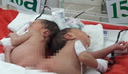 Tình hình sức khỏe cặp song sinh dính liền mông